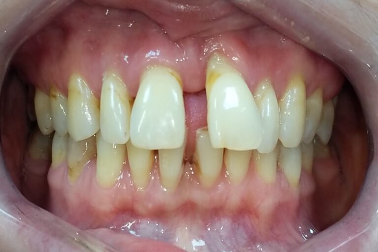 Patient's bite before orthodontic treatment (example 35)