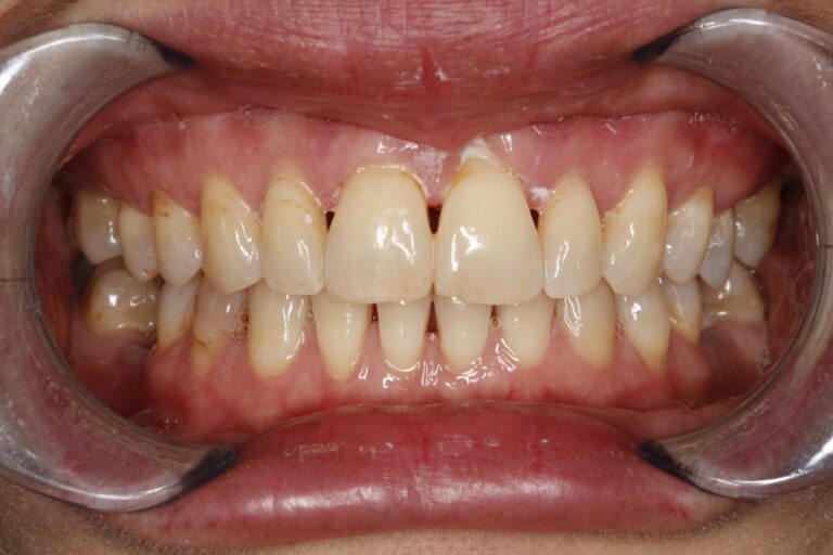 Patient's bite after clear aligner treatment (example 35)