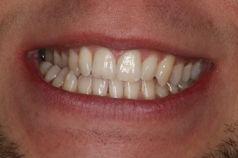 Patient's bite before orthodontic treatment (example 36)