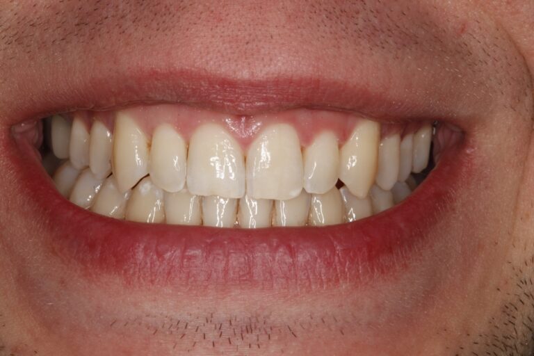Patient's bite after clear aligner treatment (example 36)