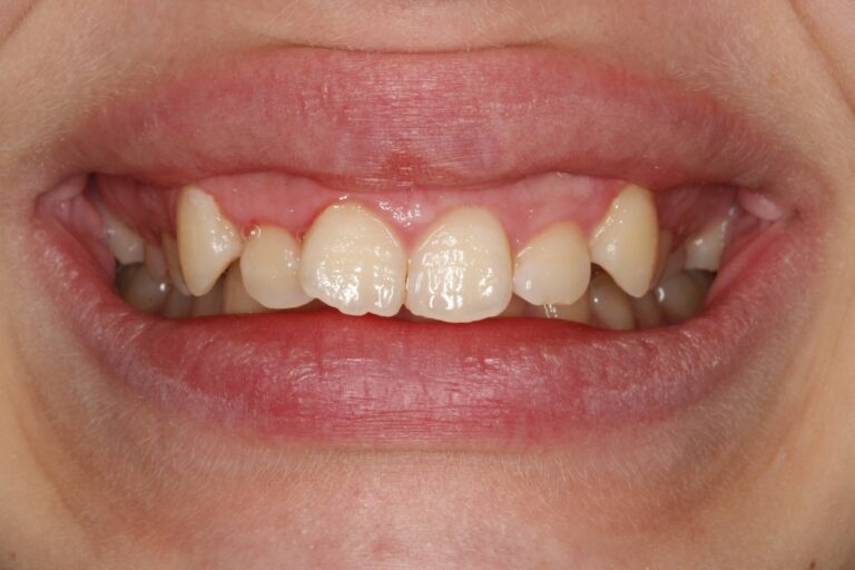 Patient's bite before orthodontic treatment (example 37)