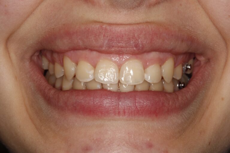 Patient's bite after clear aligner treatment (example 37)