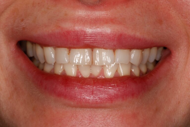 Patient's bite before orthodontic treatment (example 38)