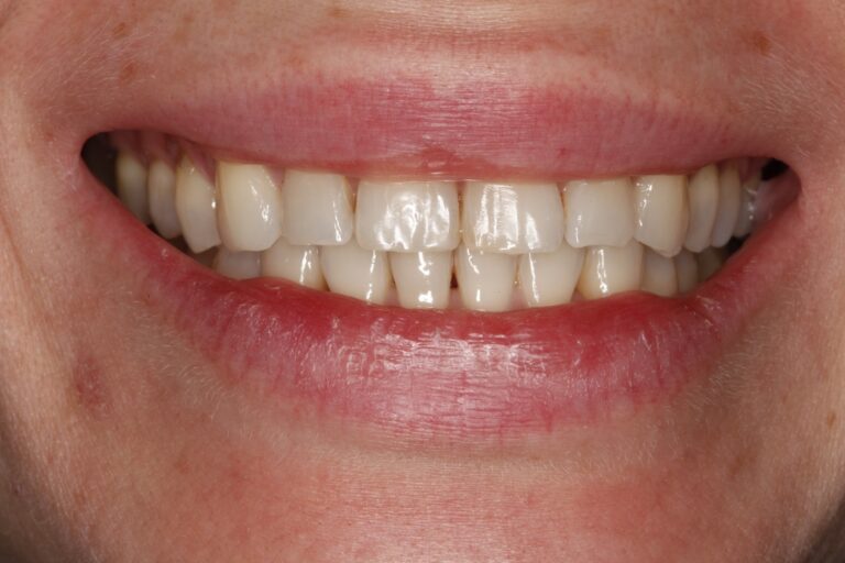 Patient's bite after clear aligner treatment (example 38)