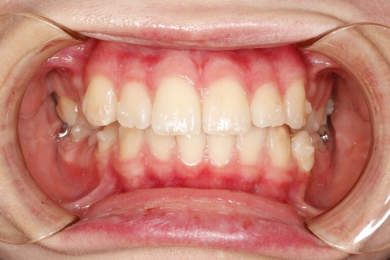 Patient's bite before orthodontic treatment (example 39)