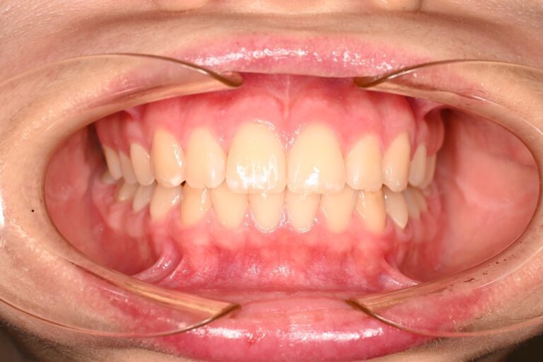 Patient's bite after clear aligner treatment (example 39)