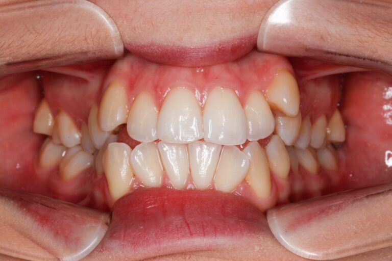 Patient's bite before orthodontic treatment (example 3)