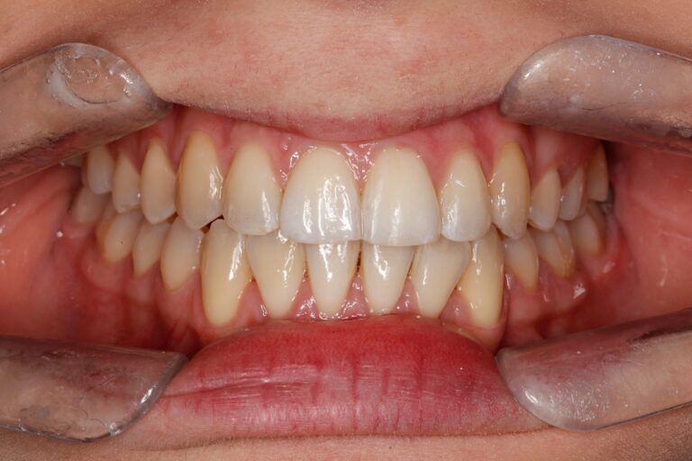 Patient's bite after clear aligner treatment (example 3)