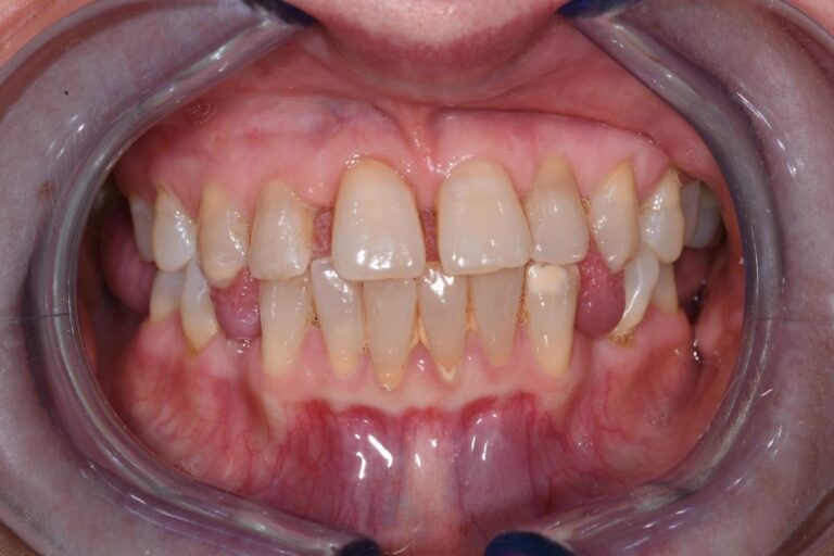 Patient's bite before orthodontic treatment (example 5)