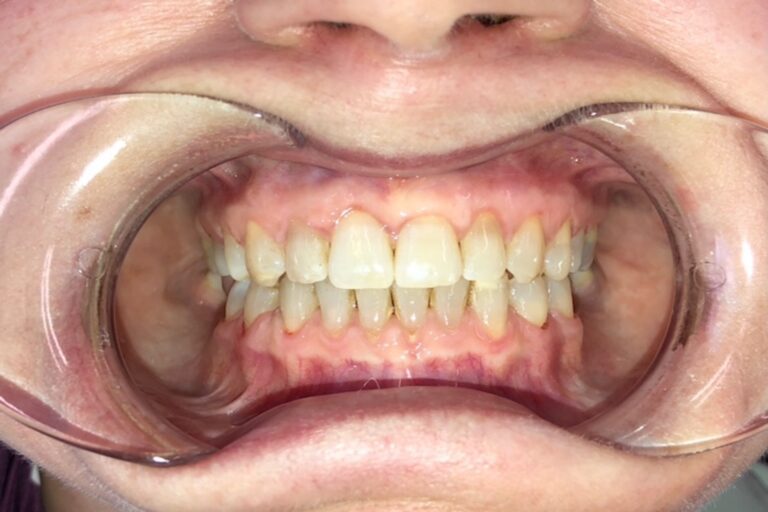 Patient's bite after clear aligner treatment (example 5)