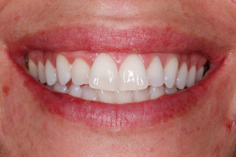 Patient's bite before orthodontic treatment (example 6)