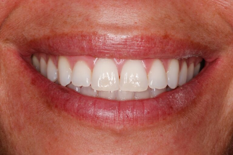 Patient's bite after clear aligner treatment (example 6)