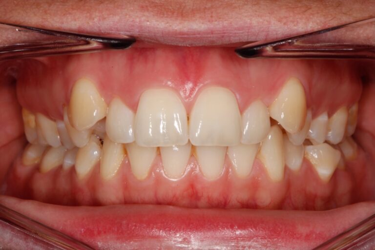 Patient's bite before orthodontic treatment (example 7)