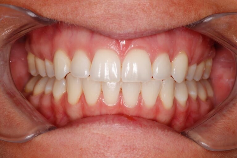 Patient's bite after clear aligner treatment (example 7)