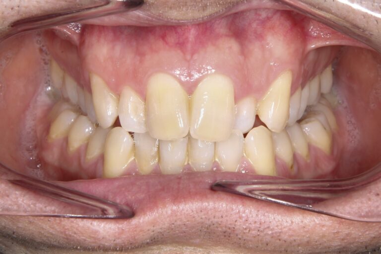 Patient's bite before orthodontic treatment (example 8)