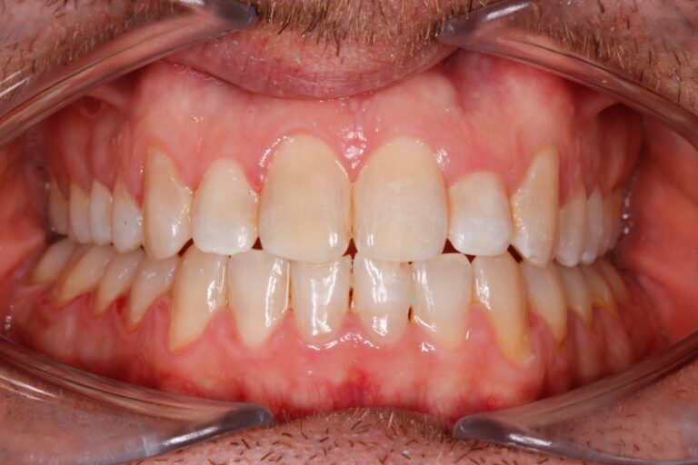 Patient's bite after clear aligner treatment (example 8)