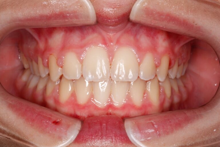 Patient's bite before orthodontic treatment (example 9)