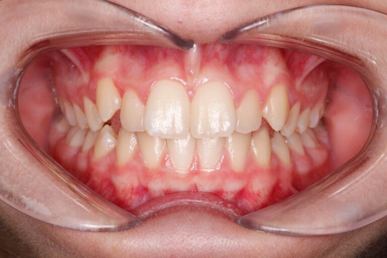 Patient's bite after clear aligner treatment (example 9)