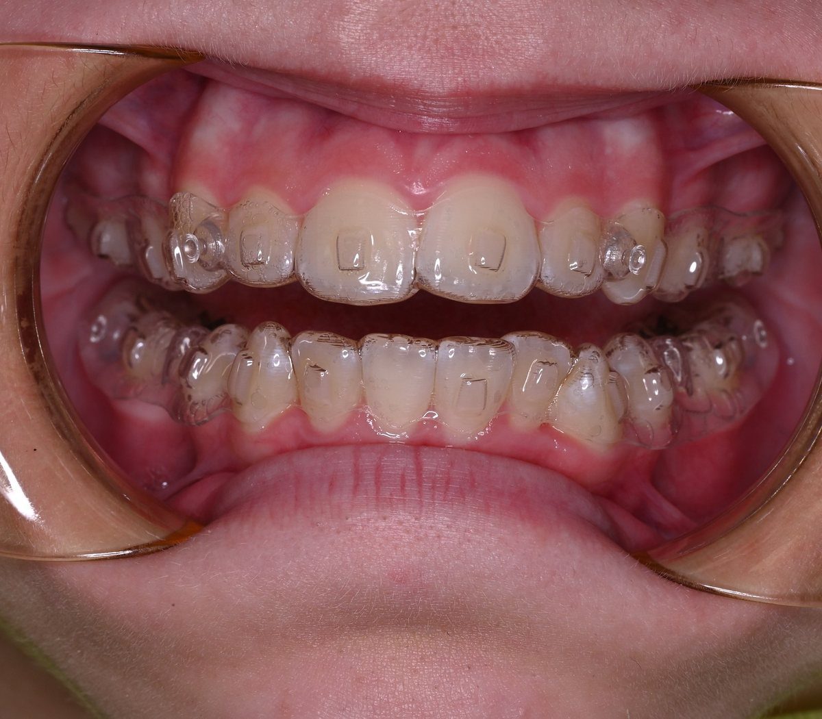 Aligners in place