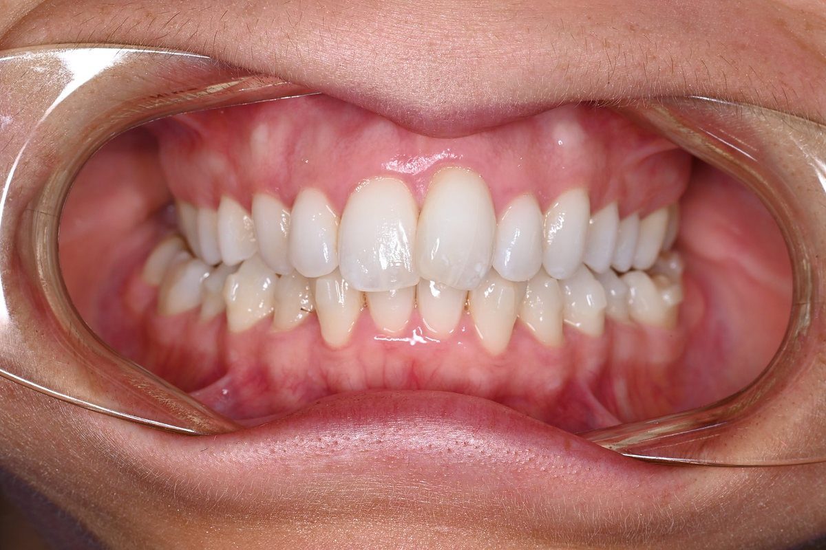 Before expansion: bilateral crossbite