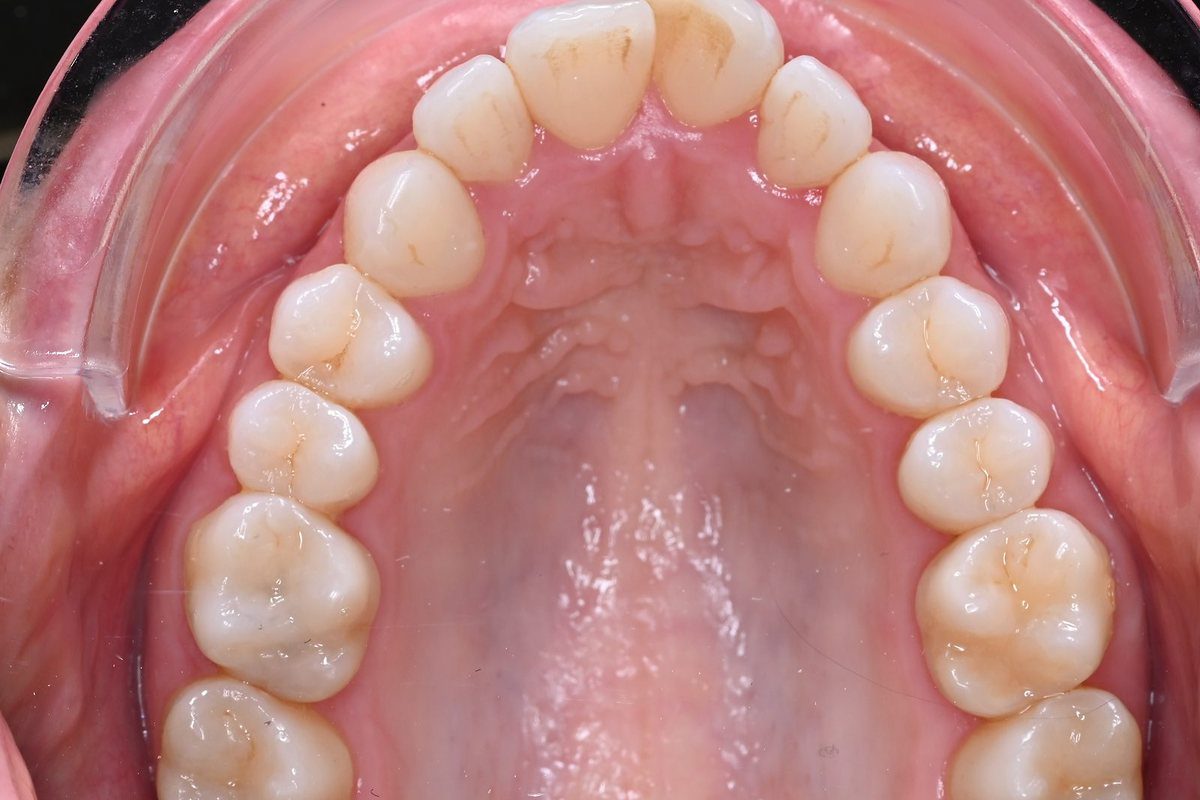 Before expansion: narrow palate