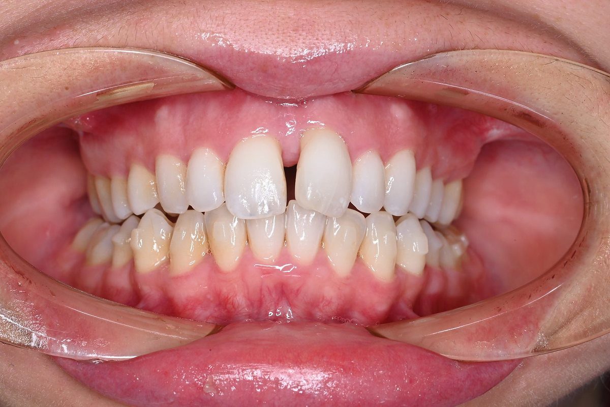 During expansion: diastema forming between the central incisors