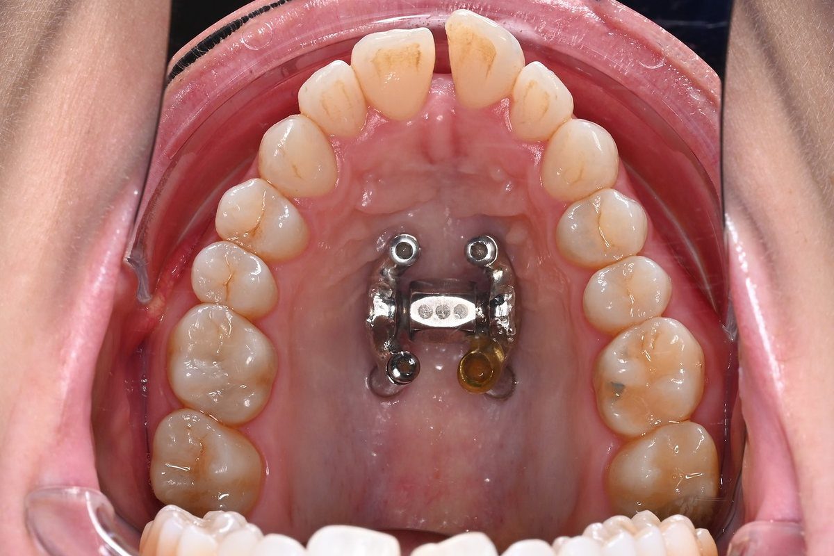 During expansion: opening of the palatal suture after minimally invasive corticotomies