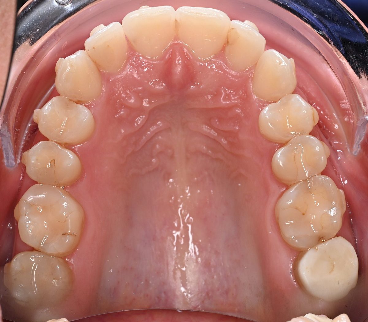 Upper arch (after)