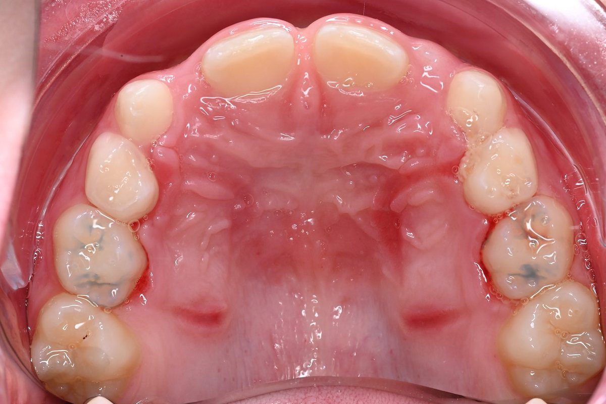 Upper arch (after)