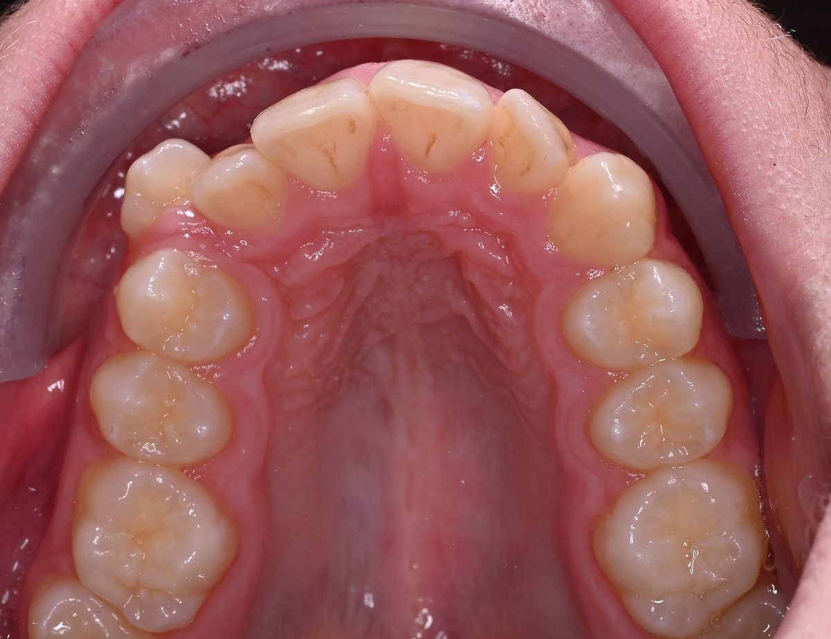 Before treatment