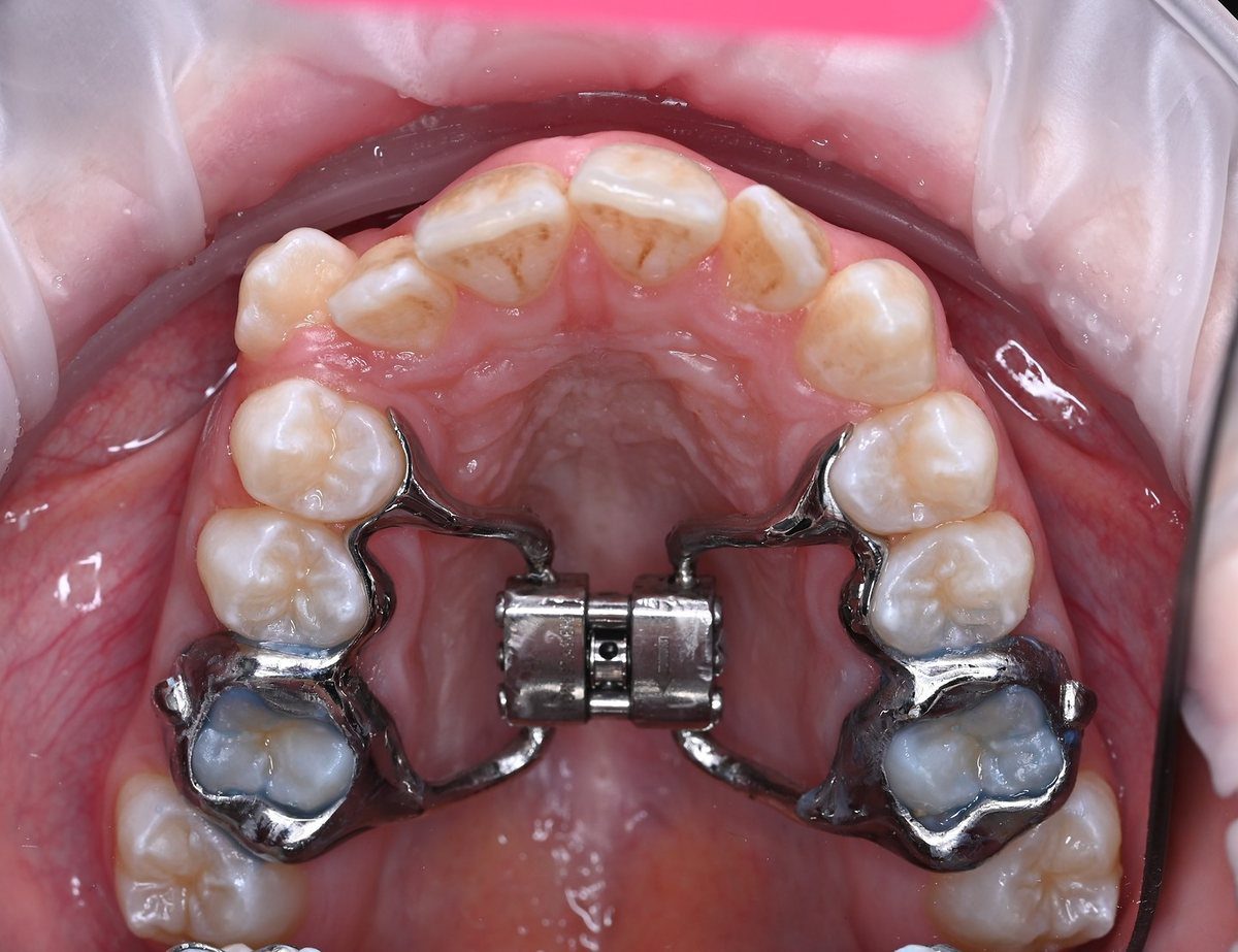 Expander on the upper jaw